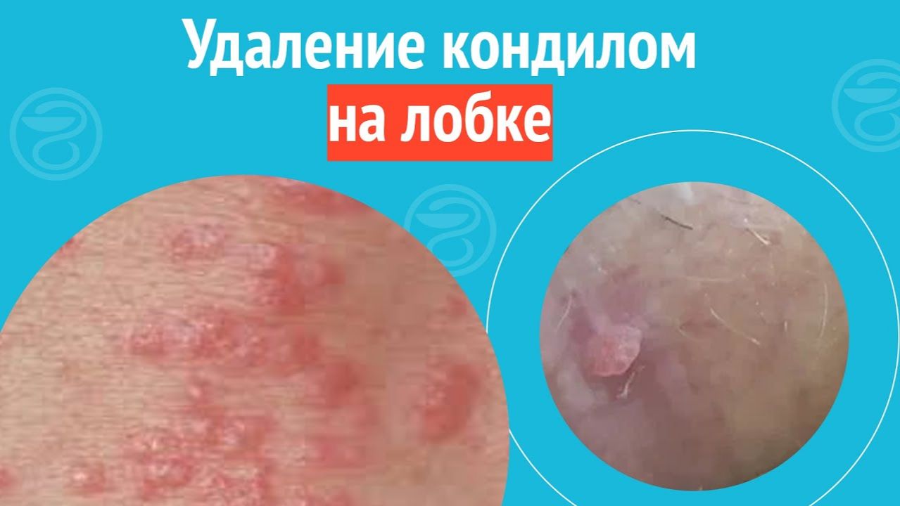 ✅ Удаление кондилом на лобке. Клинический случай №1487 смотреть онлайн