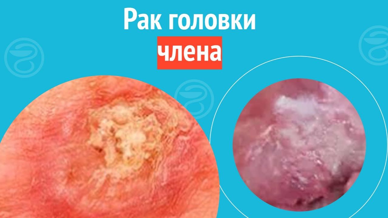 😲 Рак головки члена. Клинический случай №1478 смотреть онлайн