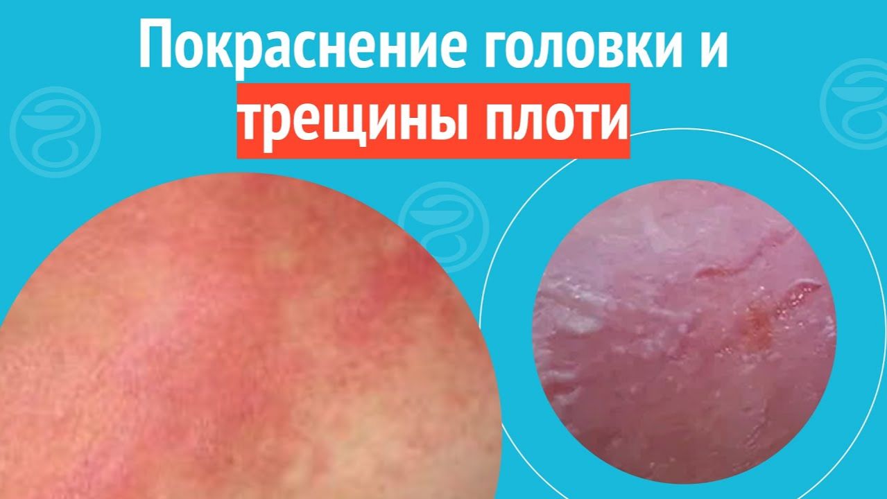 😡 Покраснение головки и трещины плоти. Клинический случай №1501 смотреть онлайн