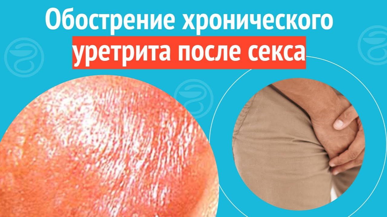 👉 Обострение хронического уретрита после секса. Клинический случай №1493 смотреть онлайн
