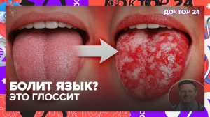 БОЛИТ И ОТЕКАЕТ ЯЗЫК? ГЛОССИТ: РЕАЛЬНЫЕ ПРИЧИНЫ, СИМПТОМЫ И ЛЕЧЕНИЕ | Доктор 24