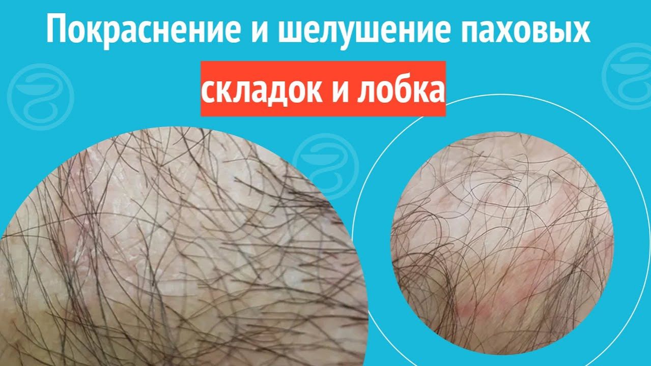 😐 Покраснение и шелушение паховых складок и лобка. Клинический случай №1469 смотреть онлайн