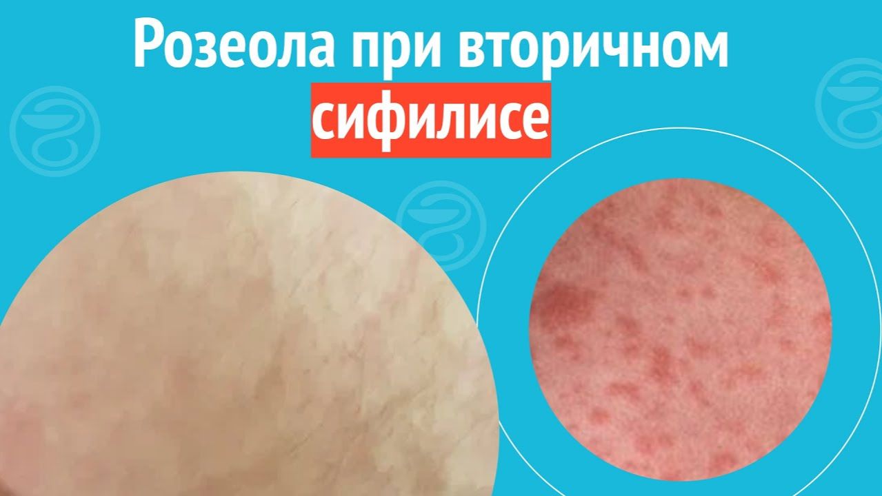 ➡️ Розеола при вторичном сифилисе. Клинический случай №1479 смотреть онлайн