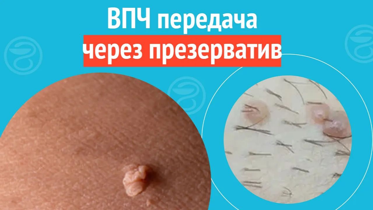 🙄 ВПЧ передача через презерватив. Клинический случай №1498 смотреть онлайн