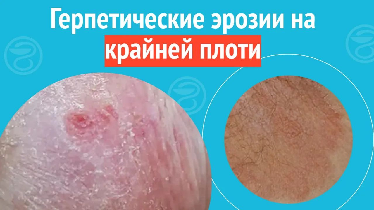 🙄 Герпетические эрозии на крайней плоти. Клинический случай №1495 смотреть онлайн