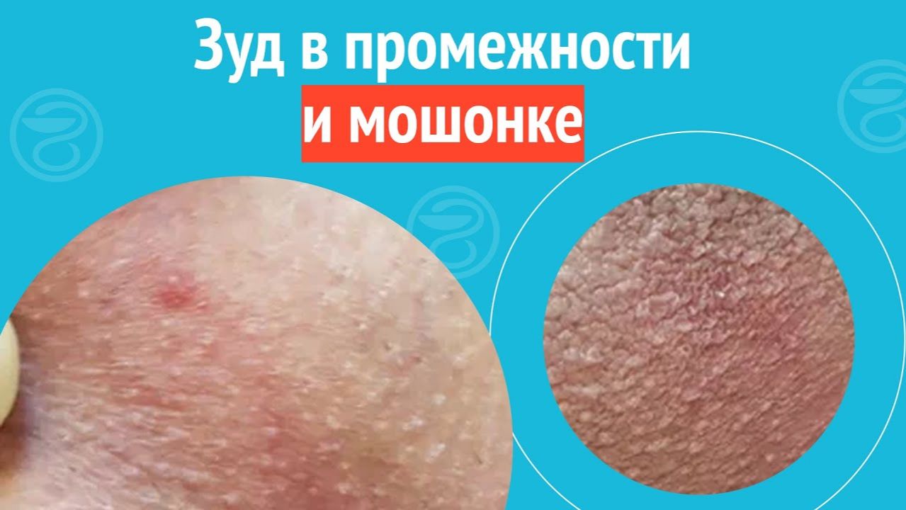 ➡️ Зуд в промежности и мошонке. Клинический случай №1472 смотреть онлайн