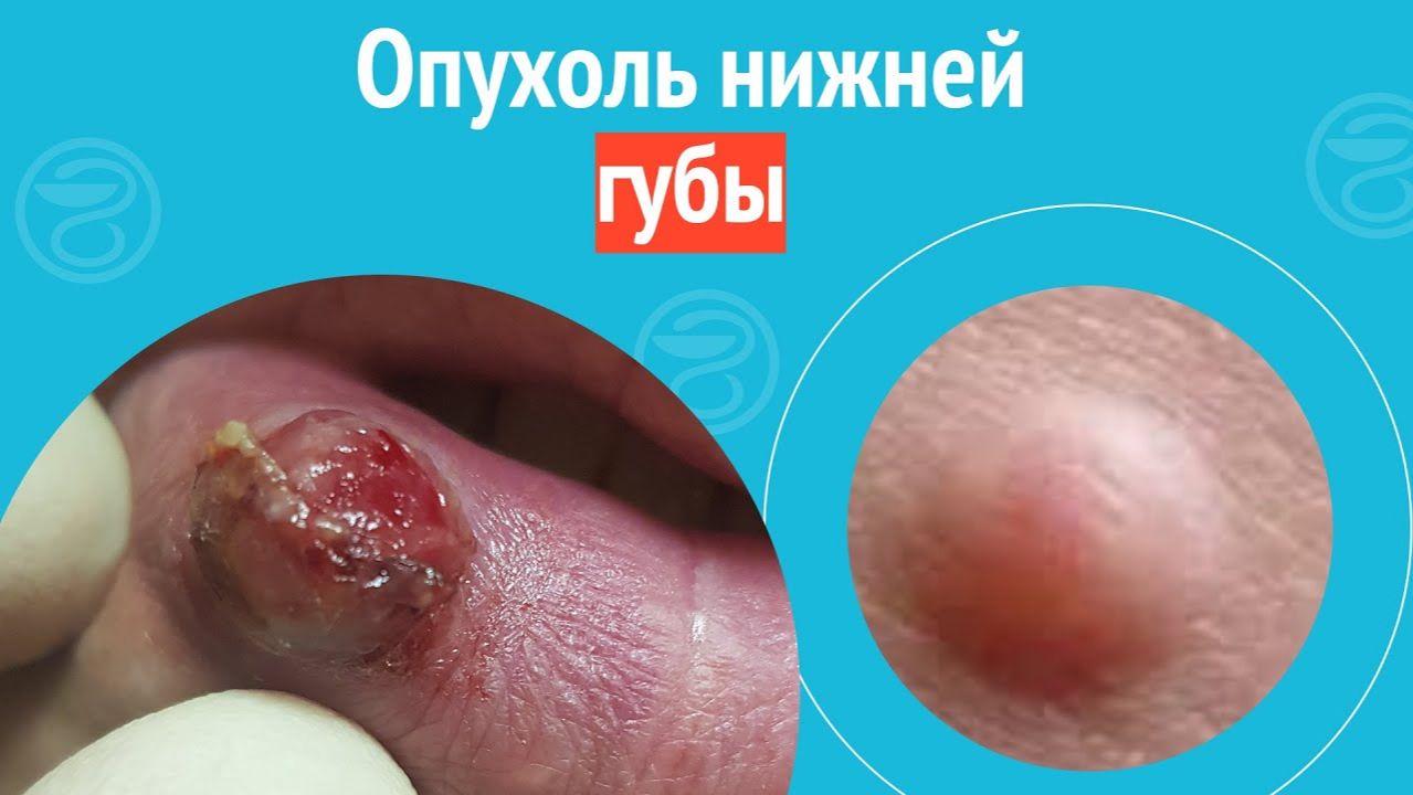 👄 Опухоль нижней губы. Клинический случай №1473 смотреть онлайн