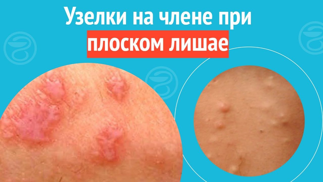 🥺 Узелки на члене при плоском лишае. Клинический случай №1489 смотреть онлайн