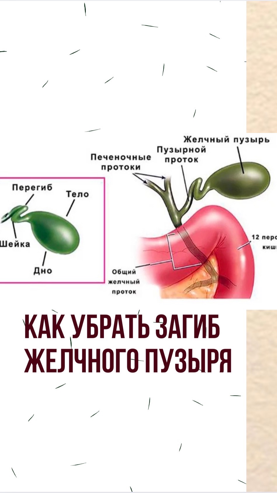 Как убрать загиб желчного пузыря смотреть онлайн
