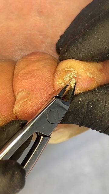 Мозоль на мизинце смотреть онлайн