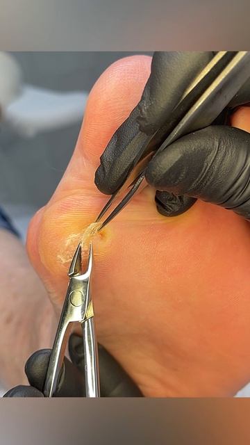 Бородавка или мозоль? смотреть онлайн