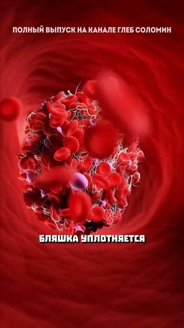 Эффекты лечения атеросклероза смотреть онлайн