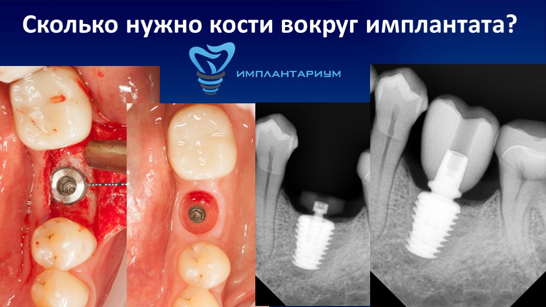 Необходимые биологические условия для долговременного успеха имплантатов (часть 2) смотреть онлайн