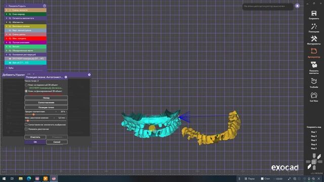 Поднятие прикуса на модели ExoCad смотреть онлайн
