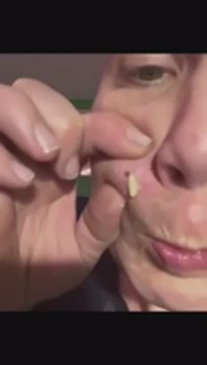 Лучшая подборка видео: Выдавливание прыщей, кист, удаление черных точек и дезинфекция Ч 25