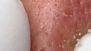 Прыщи _ Огромные прыщи _ Релакс с акне _ Выдавливание прыщей _ Черная точка #Прыщи_6