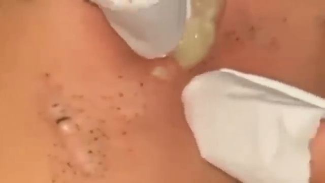 Прыщи _ Огромные прыщи _ Релакс с акне _ Выдавливание прыщей _ Черная точка #Прыщ смотреть онлайн