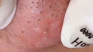 Прыщи _ Огромные прыщи _ Релакс с акне _ Выдавливание прыщей _ Черная точка