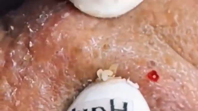 Прыщи _ Огромные прыщи _ Релакс с акне _ Выдавливание прыщей _ Черная точка #Прыщи_8 смотреть онлайн