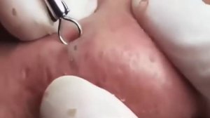 Выдавливание чёрных точек. #комедоны #проблемнаякожа #уходзалицом