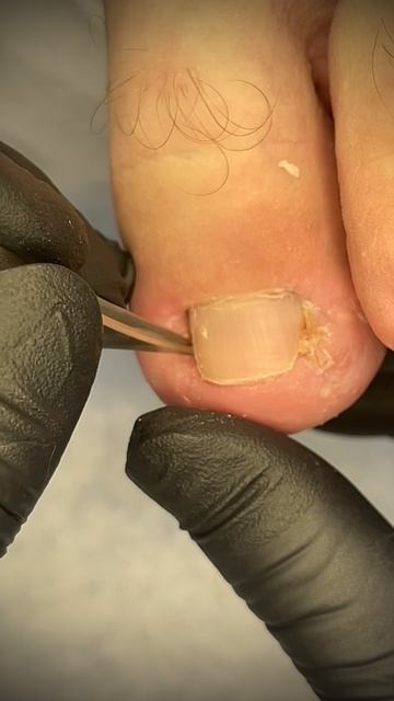 Скобы для вросшего ногтя смотреть онлайн