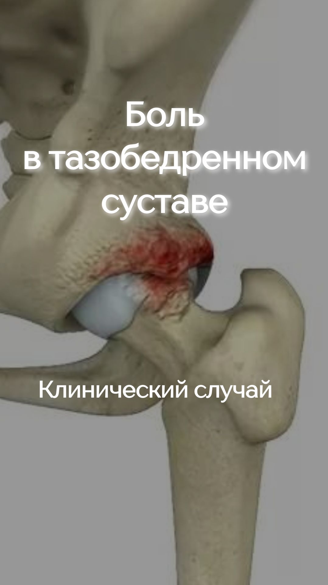 Боль в тазобедренном суставе. Клинический случай