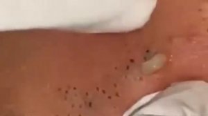 Чёрные точки _ Релакс _ Выдавливание прыщей _ #Прыщи #чёрнаяточка