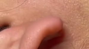 Прыщи  Огромные прыщи Выдавливание прыщей Черная точка #Прыщи