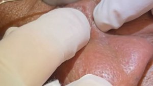 Мощное выдавливание. Черные точки, белые угри. Чистка носа. #чистканоса #черныеточки #белыеугри