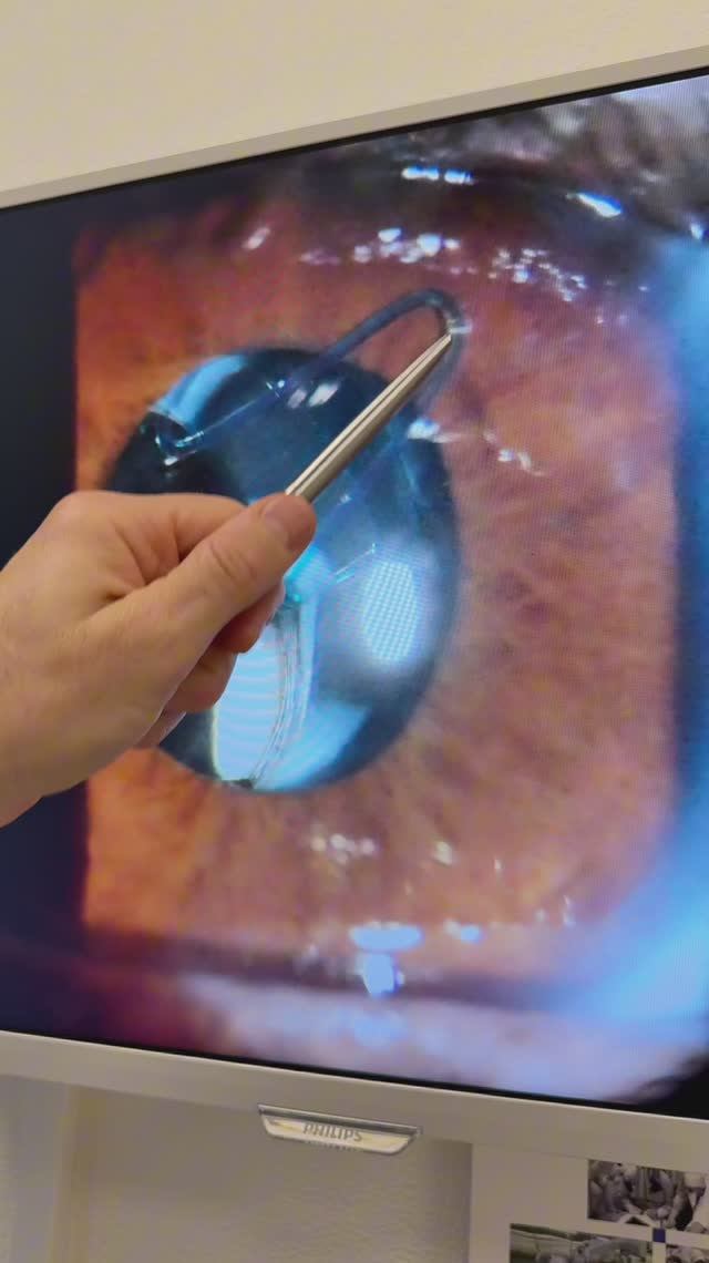 Синдром Марфана. ПОВТОРНАЯ ОПЕРАЦИЯ ЧЕРЕЗ 16 ЛЕТ ЗАМЕНА ИОЛ В КАПСУЛЬНЫЙ МЕШОКПРИ СИНДРОМЕ МАРФАНА. смотреть онлайн