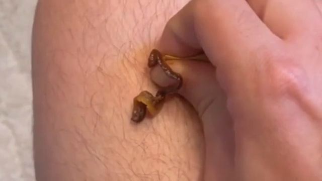 ПРЫЩИ 😱 Огромные прыщи 😯 Релакс с акне _ Выдавливание прыщей _ Черная точка #Прыщи смотреть онлайн