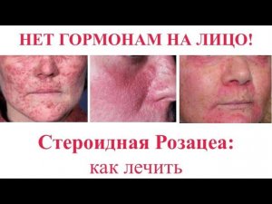 СТЕРОИДНАЯ РОЗАЦЕА: механизмы и как лечить