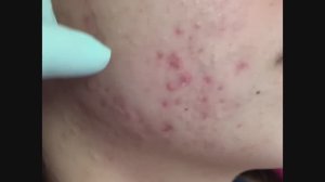 Ваши любимые видео удаления акне #4. 20 минут чистого "попа". Чистка ушей, в этом видео есть всё.