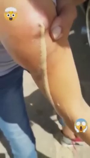 Лучшая подборка видео: Выдавливание прыщей, кист, удаление черных точек и дезинфекция Ч 17