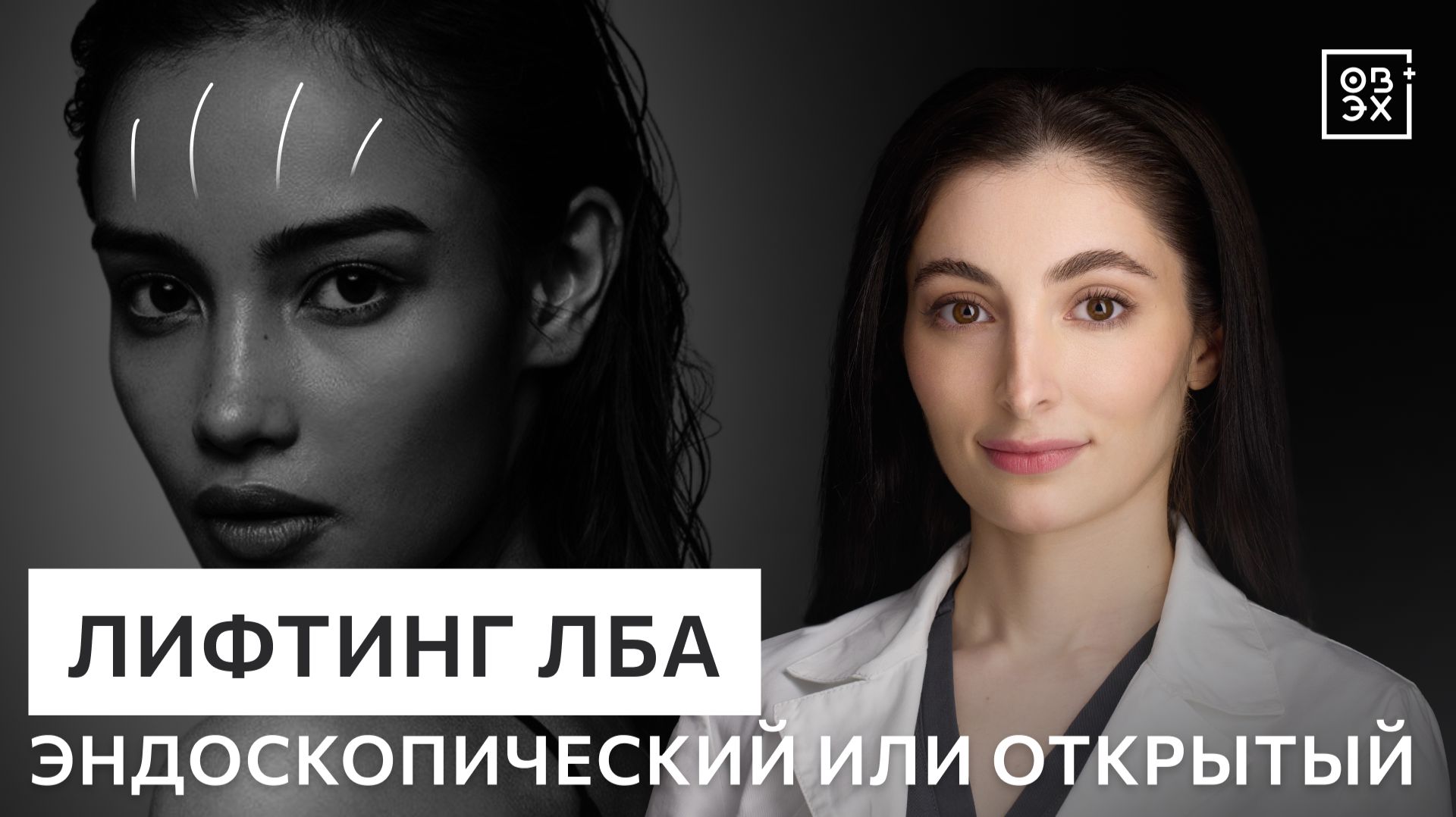 Лифтинг лба и бровей: отличия методик. Эндоскопический или открытый? Показания и результаты смотреть онлайн