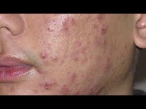 АНТИБИОТИКИ при акне и розацеа (лекция в хорошем качестве)