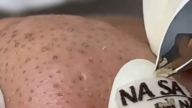 Огромные прыщи _ Релакс с акне _ Выдавливание прыщей _ Черная точка #Прыщи смотреть онлайн