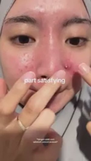 Лучшая подборка видео: Выдавливание прыщей, кист, удаление черных точек и дезинфекция Ч 23
