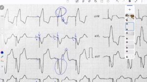 Разбор ЭКГ ПЭКС и ОКС