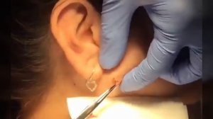 Лучшая подборка видео: Выдавливание прыщей, кист, удаление черных точек и дезинфекция Ч8