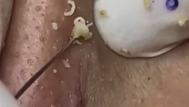 Прыщи _ Огромные прыщи _ Релакс с акне _ Выдавливание прыщей _ Черная точка #Прыщи_9 смотреть онлайн