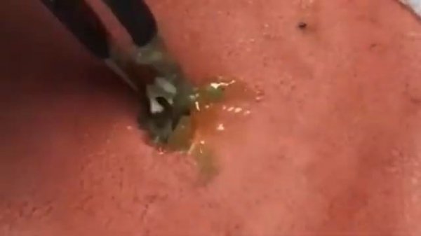 Прыщи _ Огромные прыщи _ Релакс с акне _ Выдавливание прыщей _ Черная точка #Прыщи_4