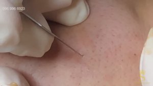 Супер-чёрные точки. Впечатляющая процедура. #суперчерныеточки #чистканоса