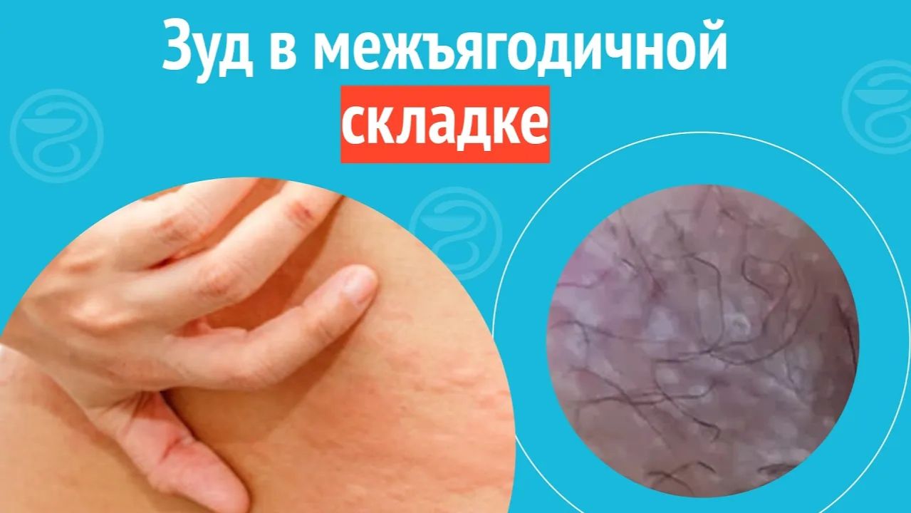 😦 Зуд в межъягодичной складке. Клинический случай №1463 смотреть онлайн