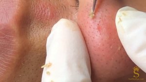 Белые угри (закрытые комедоны) на щеках. #белыеугри #прыщиначеках #комедоны #чисткалица