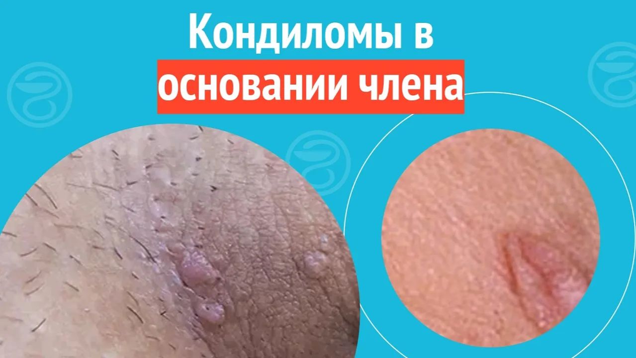 👉 Кондиломы в основании члена. Клинический случай №1462 смотреть онлайн