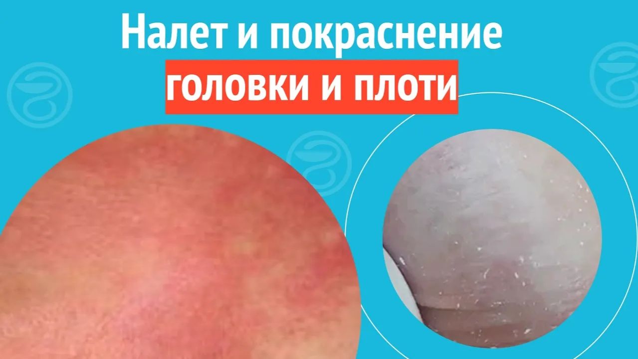 😯 Склероз головки и плоти. Клинический случай №1460 смотреть онлайн