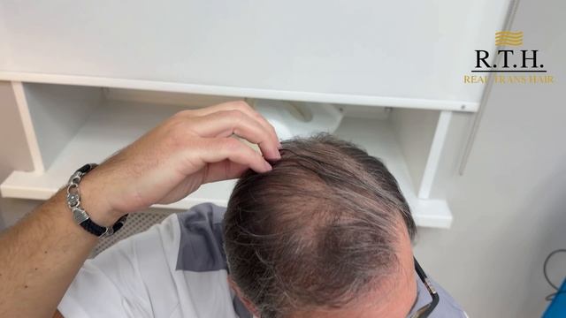 Пересадка волос — это навсегда? смотреть онлайн