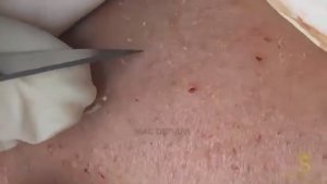 Удаление черных и белые угри у своей клиентки. #удалениеугрей #чисткалица