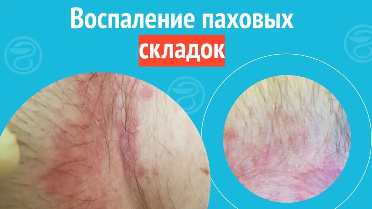 😨 Воспаление паховых складок. Клинический случай №1466 смотреть онлайн